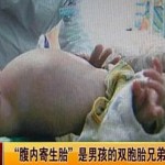 Двегодишно дете роди със секцио близнак